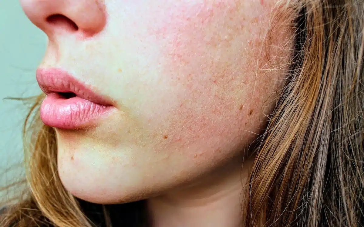 peau acnéique